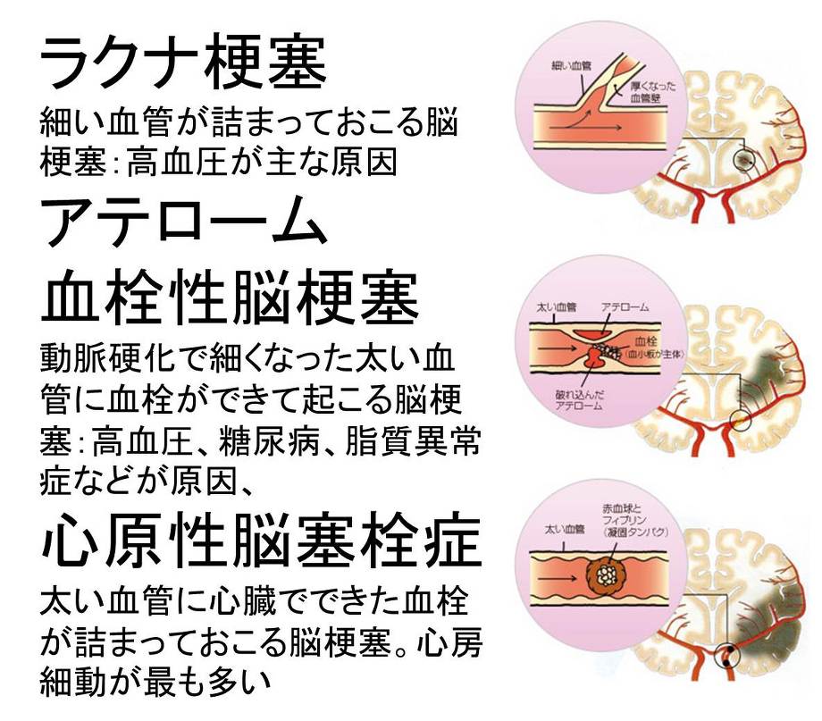 CardioーCoagulation Vol.4 No.2 2017―循環器における抗凝固療法 心房細動リスクスコアを整理する CardioーCoagulation Vol.4 No.2 2017―循環器における抗凝固療法
